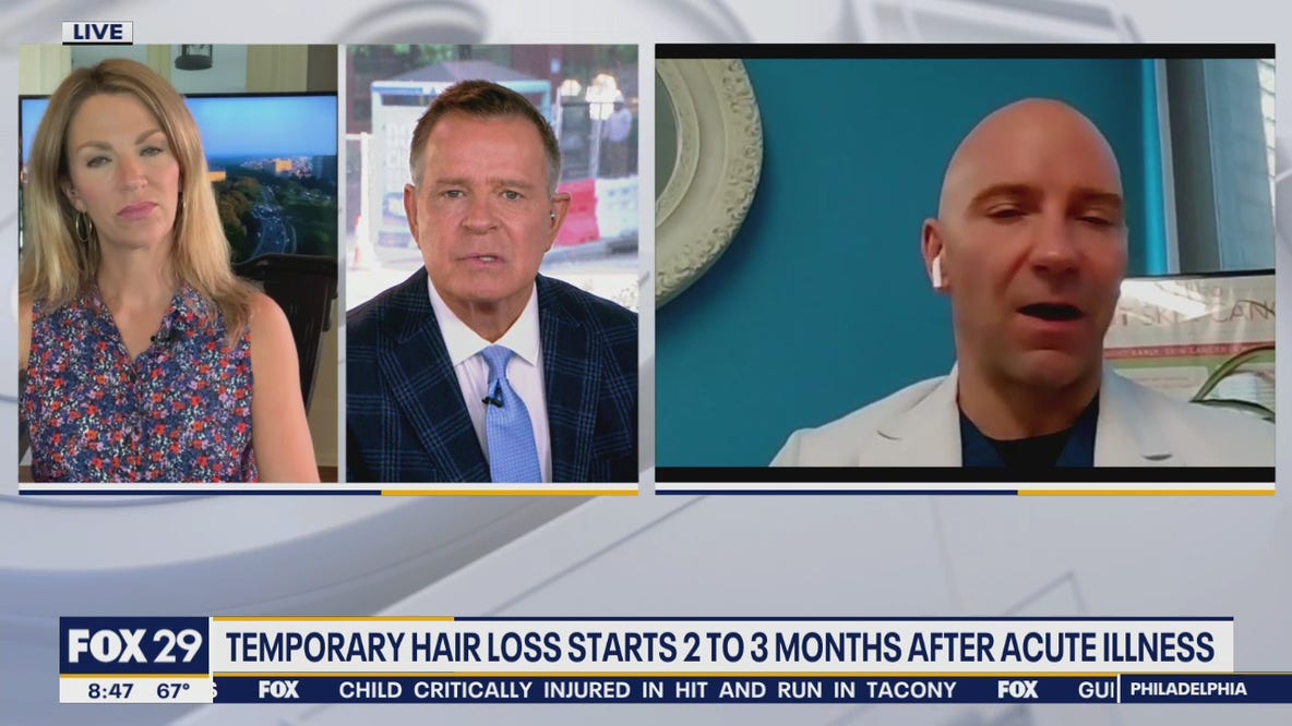 Some coronavirus survivors suffering from hair loss after recovering